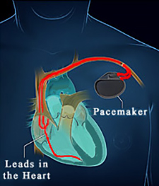 Phoenix pacemaker placement
